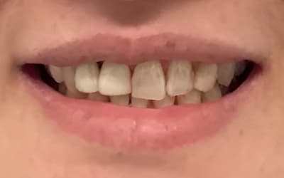 Before treatment