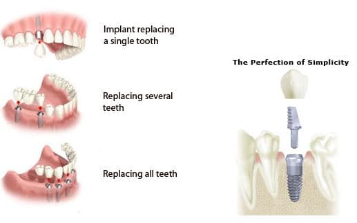 dental implants