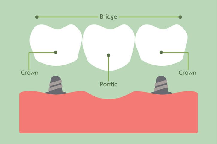 dental implants