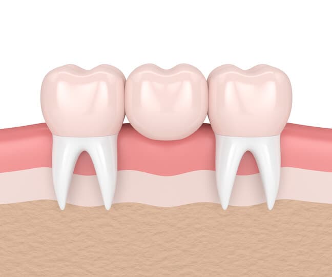 dental implants