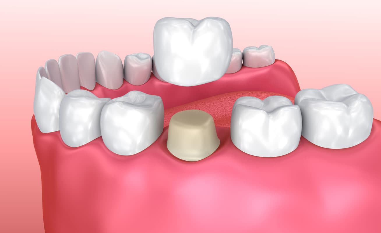 dental implants