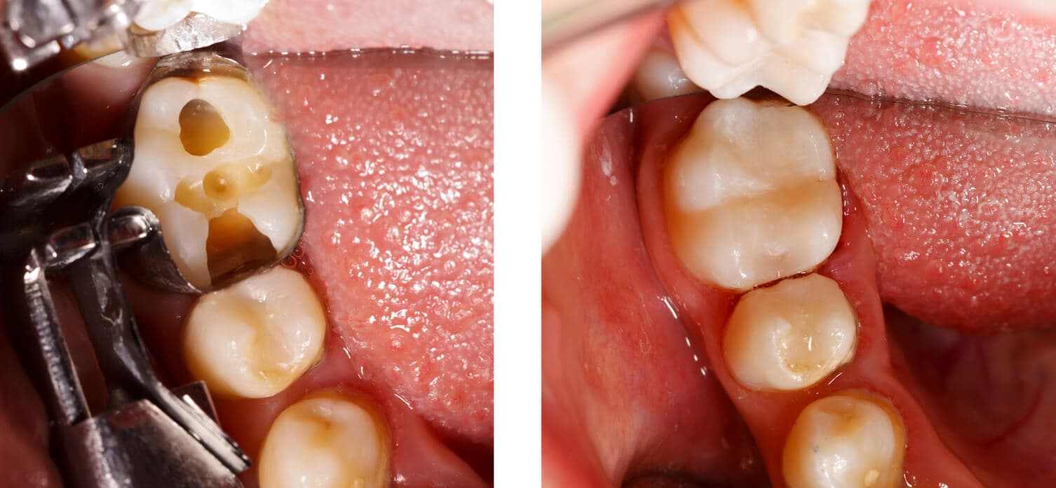 Composite Filling