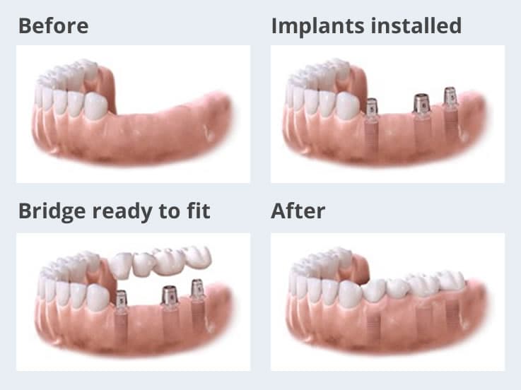 implants multiple teeth graphic